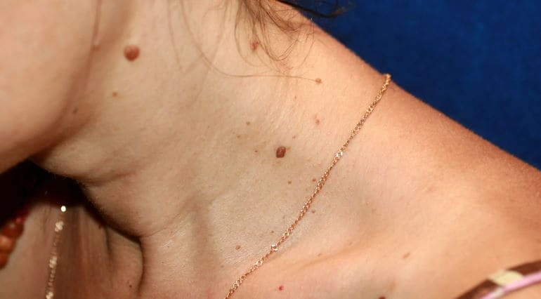 Alergije i promene na koži (papilomi)